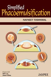 Simplified Phacoemulsification / Toshniwal, Navneet 